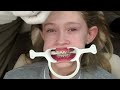 Putting Braces On – See how it is done!