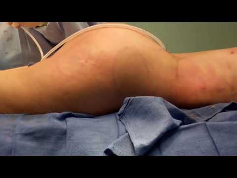 brazil plastic surgery - I have always been self conscious about the shape and and size of my buttocks. I had the brazilian butt lift surgery with Dr. Cortes. Dr. Cortes is a Houston...