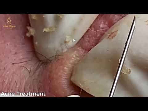 BLACKHEADS TREATMENT FOR a handsome boy (54) | Loan Nguyen