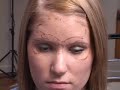 BOTOX PLANO DALLAS TUTORIAL: UPPER FACE BOTOX PLANO DALLAS TUTORIAL: UPPER FACE