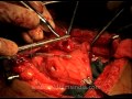 Wait till you see how these doctors perform amazing abdominal surgery. All caught on tape. This will for sure leave you awe struck! Not for the faint hearted. Celiotomy, else known as Open abdominal surgery or laparotomy refers to any surgical operation in which the abdomen is opened to access or inspect the organs of the abdominal cavity. Traditionally, surgeons perform the majority of gynecologic surgery using an 