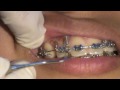 Upper anterior intrusion suspended and incisor retraction started