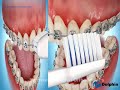 Brushing with Braces (Poor Hygiene)
