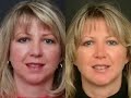 Chin Augmentation New Jersey Chin Augmentation New Jersey