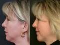 Chin Augmentation New Jersey