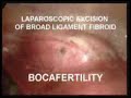 Laparoscopic Resection of a Broad Ligament Fibroid