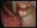 Laparoscopic Resection of a Broad Ligament Fibroid