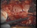 Dr. Ali Bydon Performs A Spinal Synovial Cyst Resection