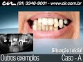Protocolo superior e inferior é o nome dado a técnica que substitui todos dentes na arcada superior e inferior através de implantes dentários. O implante dental é um pequeno cilindro confeccionado em titânio puro, com roscas externas semelhante a um parafuso. O titânio adere ao tecido ósseo, produzindo uma ligação biológica entre o osso eo titânio, conhecida como osseointegração.