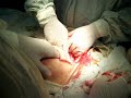ovarian mass after cs hysterectomy