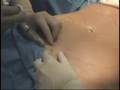 SmartLipo Melts Fat and Tightens Skin