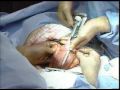 Proximal Gastrectomy and Distal Esophagectomy for Gastro-esopahageal junction Carcinoma