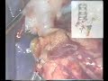 Bronchial revascularization in exper. single lung transplant