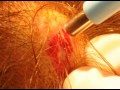 Sebaceous Cyst Removal Using The Punch Biopsy Technique