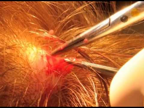 how to unclog sebaceous cyst