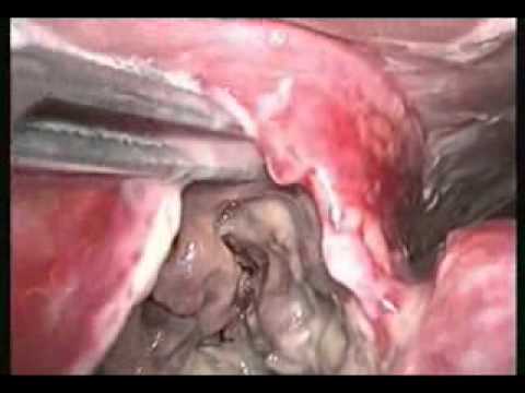 how to drain liver abscess