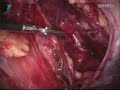 Laparoscopic TAPP Hernia Repair Laparoscopic Hernia Repair