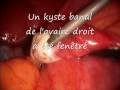 Kyste de l'ovaire coelio