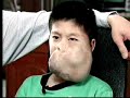 Disfigured boy denied surgery