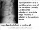 Spondylothesis and Back Pain
