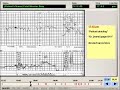 AMICUS: Fetal Monitor Strip AMICUS: Fetal Monitor Strip
