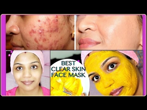 Best Acne Treatment | How to Get Flawless Skin | Skin Care Routine | SuperPrincessjo