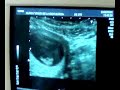 Mi bebe, con 11 semanas