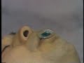 OropharyngealAirway.wmv