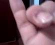 Infected finger... follow up III