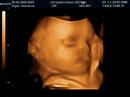 3D Ultrasound of Jacob - 3