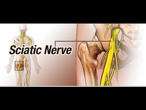 how to control sciatic pain