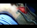 Brian Deegan Surgery