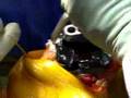 Total Knee Replacement Surgery