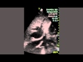 Cava And Hepatic Veins Dilation Cava And Hepatic Veins Dilation