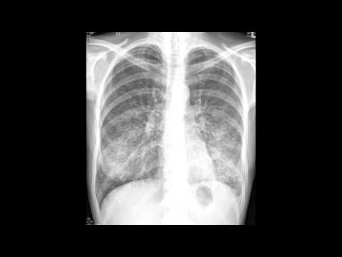 how to relieve walking pneumonia