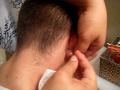 lancing my friends cyst, on back of ear
