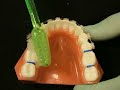 Bracesquestions.com – Separators, Spacers: How to Replace