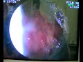 Trichobezoar in young girl\