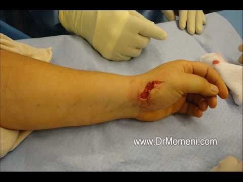 how to treat cmc joint pain