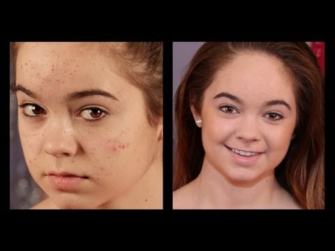 Acne Coverage Foundation Routine!
