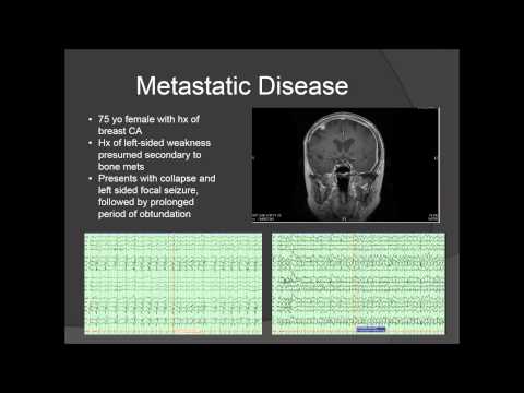 What you need to know if you have a brain tumor and epilepsy – Jeffrey Politsky, MD