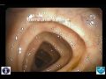 A Normal Colonoscopy