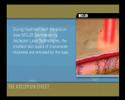 Removal of dermal lesions with Erbium laser from Asclepion