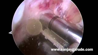 Arthroscopic ACL reconstruction Knee