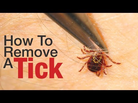 video-linktoworks-How To Remove A Tick