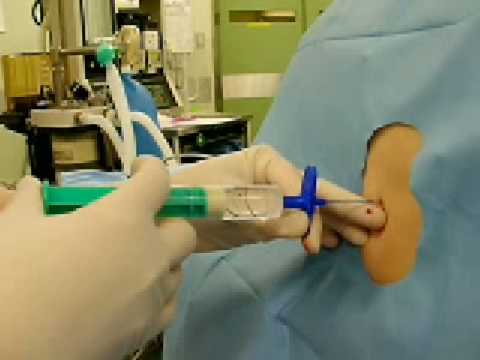 how to perform epidural anaesthesia