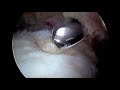 Dr Bartholomew Arthroscopic Rotator Cuff Repair