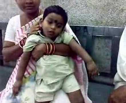 Post-encephalitis hemiplegia