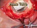 Ahmed Valve and Scleral Buckle Revision