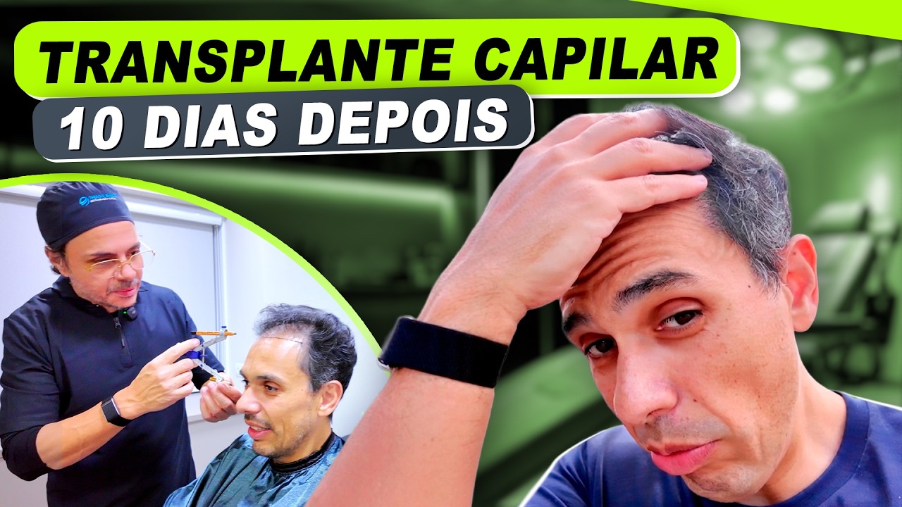 10 Dias de Transplante Capilar.Vem Ver o que Deu... 😱  #macmasi #institutothiagobianco